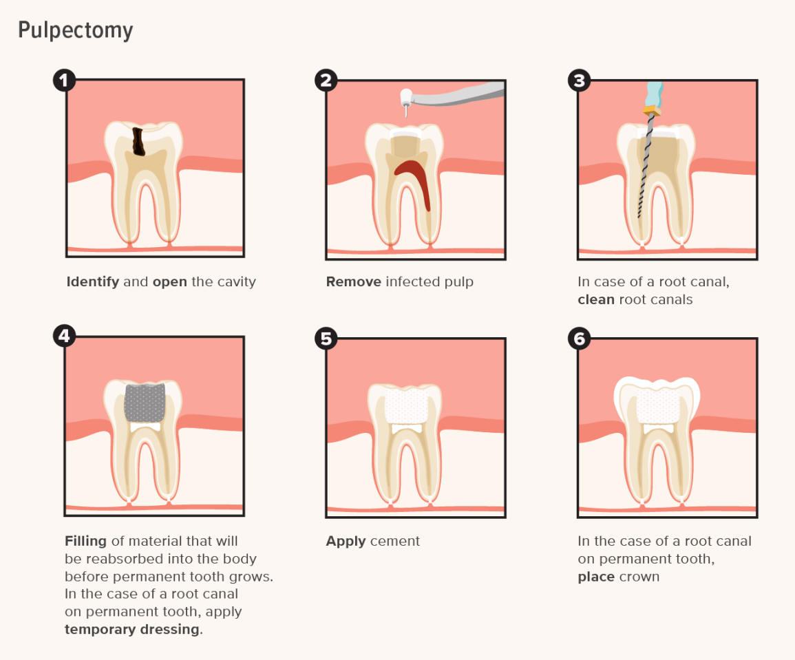 Pulpectomy Procedure