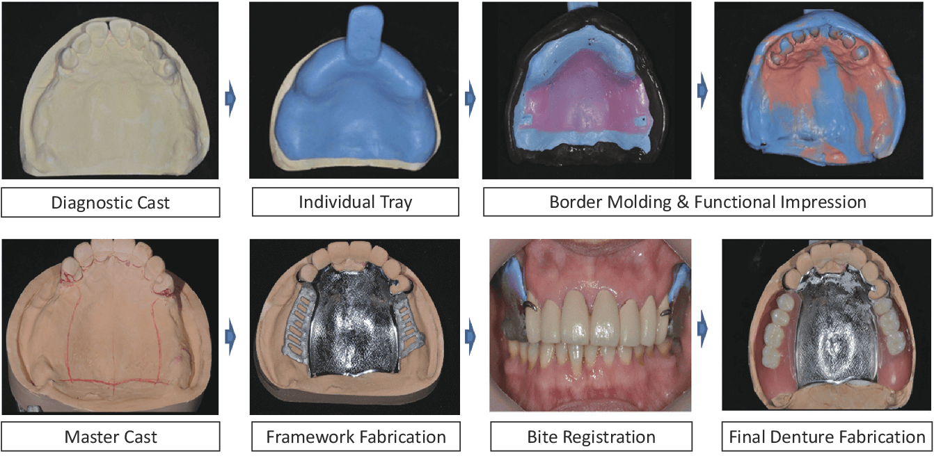 Removable Dentures