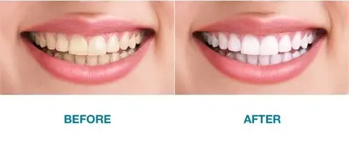 Tooth Whitening Figure